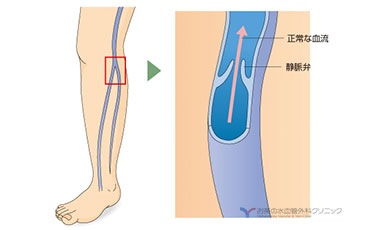正常な静脈の説明図