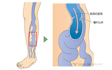 下肢静脈瘤の説明図